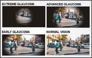 glaucoma vision